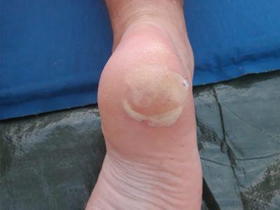 Hoe blaren te vermijden?